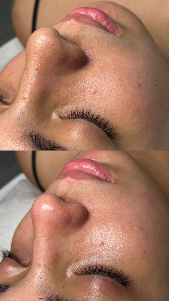 Antes e depois de tratamento de limpeza de pele